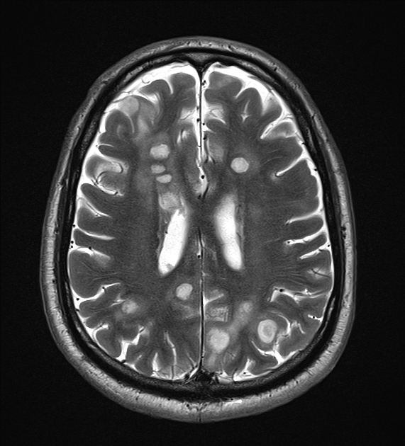 Serebral Abses