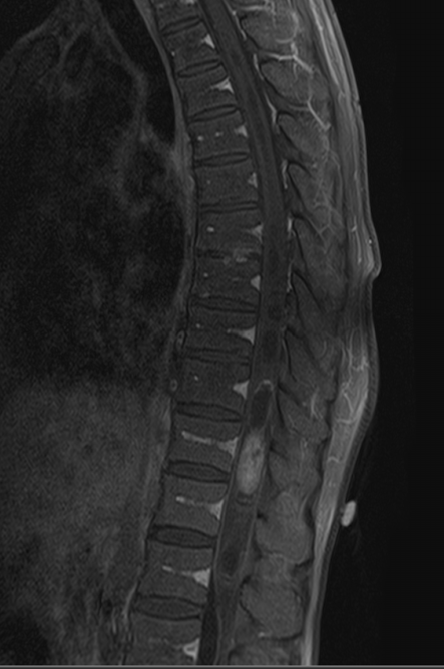 Spinal hemangioblastoma — şəkil 4