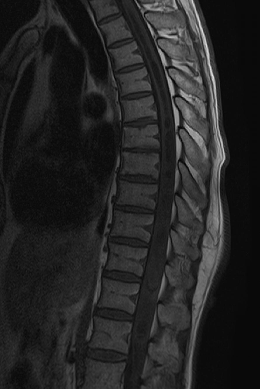 Spinal hemangioblastoma — şəkil 2