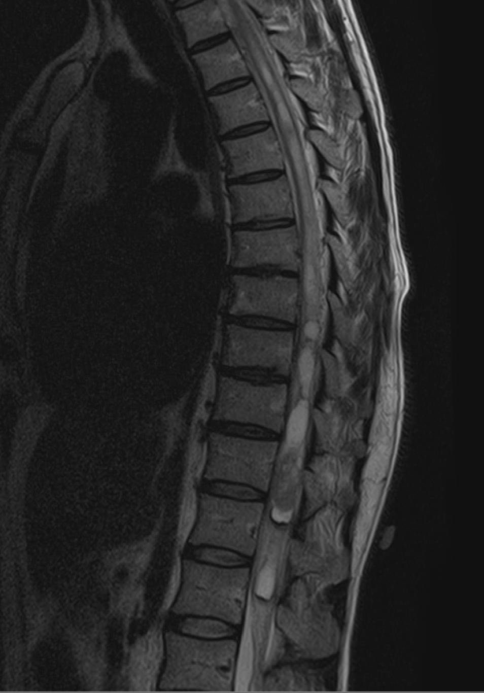 Spinal hemangioblastoma — şəkil 3